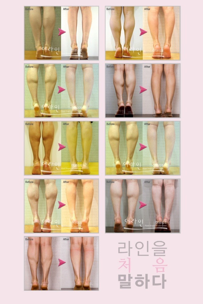 잘맞는 사람은 신세계라고하는 보톡스.jpg | 인스티즈