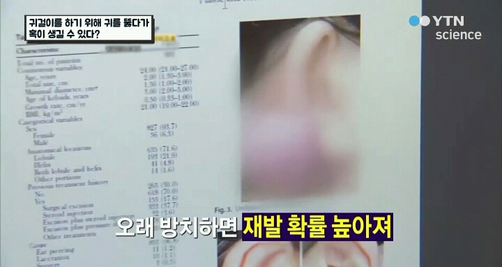 귀걸이하려다 수술까지.jpg (사진주의) | 인스티즈