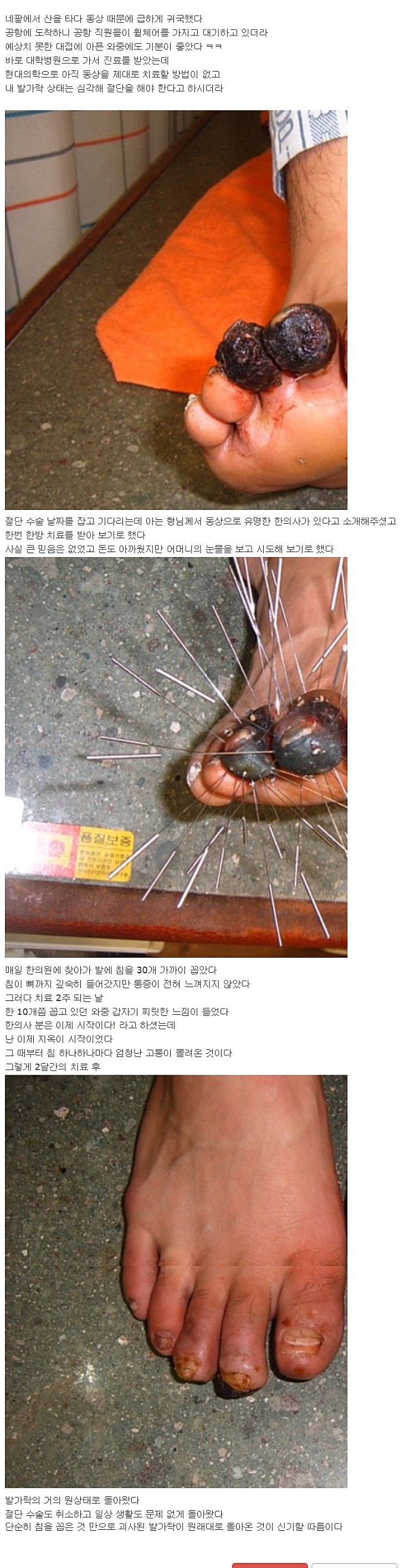 혐주의)동상환자 치료기..jpg | 인스티즈